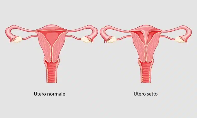 uterine septum